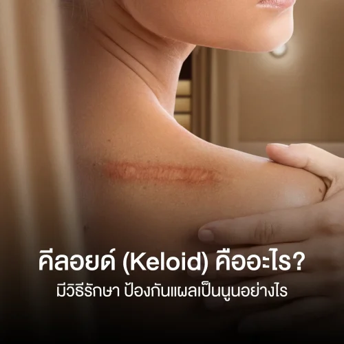 คีลอยด์ (Keloid) คืออะไร? มีวิธีรักษา ป้องกันแผลเป็นนูนอย่างไร
