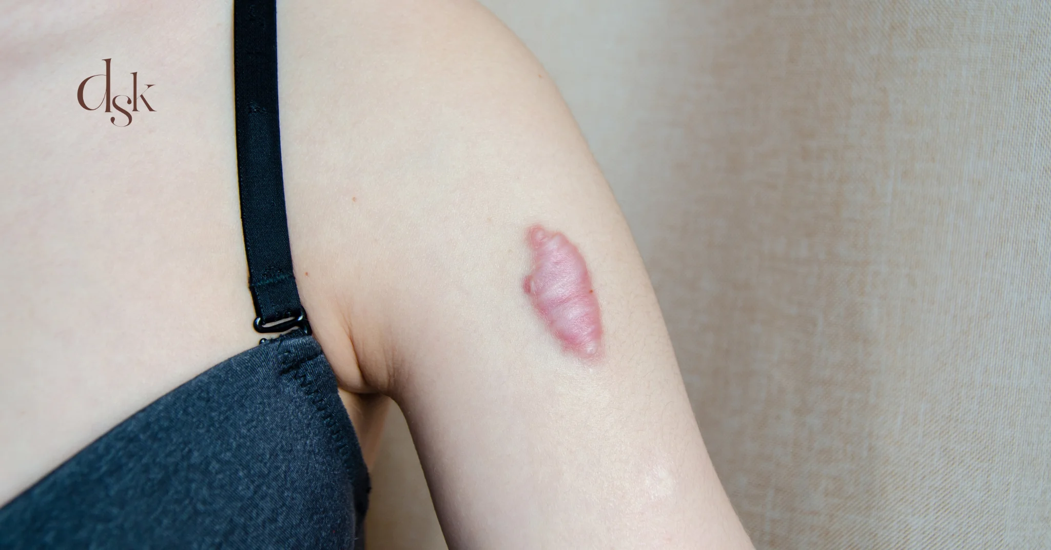 คีลอยด์ คืออะไร