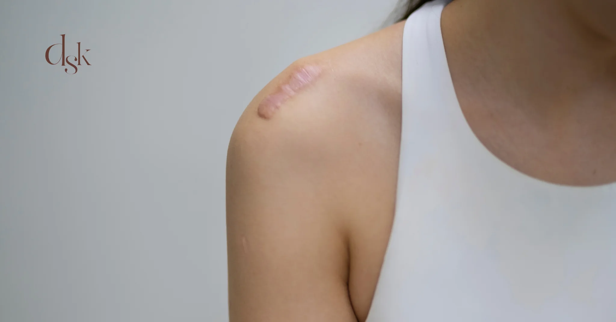 ลักษณะอาการและตำแหน่งที่พบบ่อยของคีลอยด์