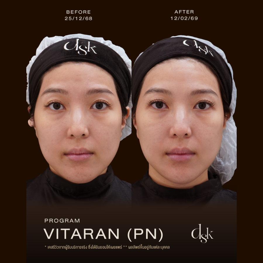vitaran รีวิว