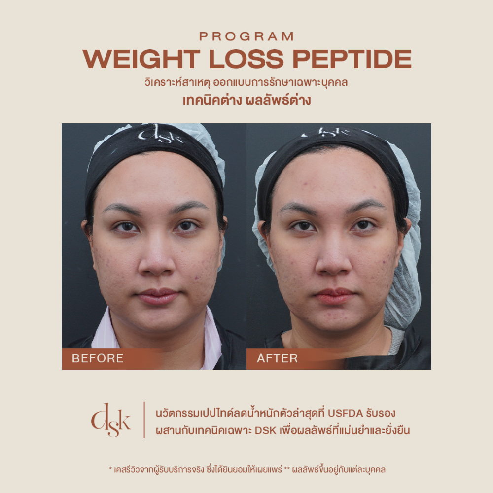 รีวิว Mounjaro