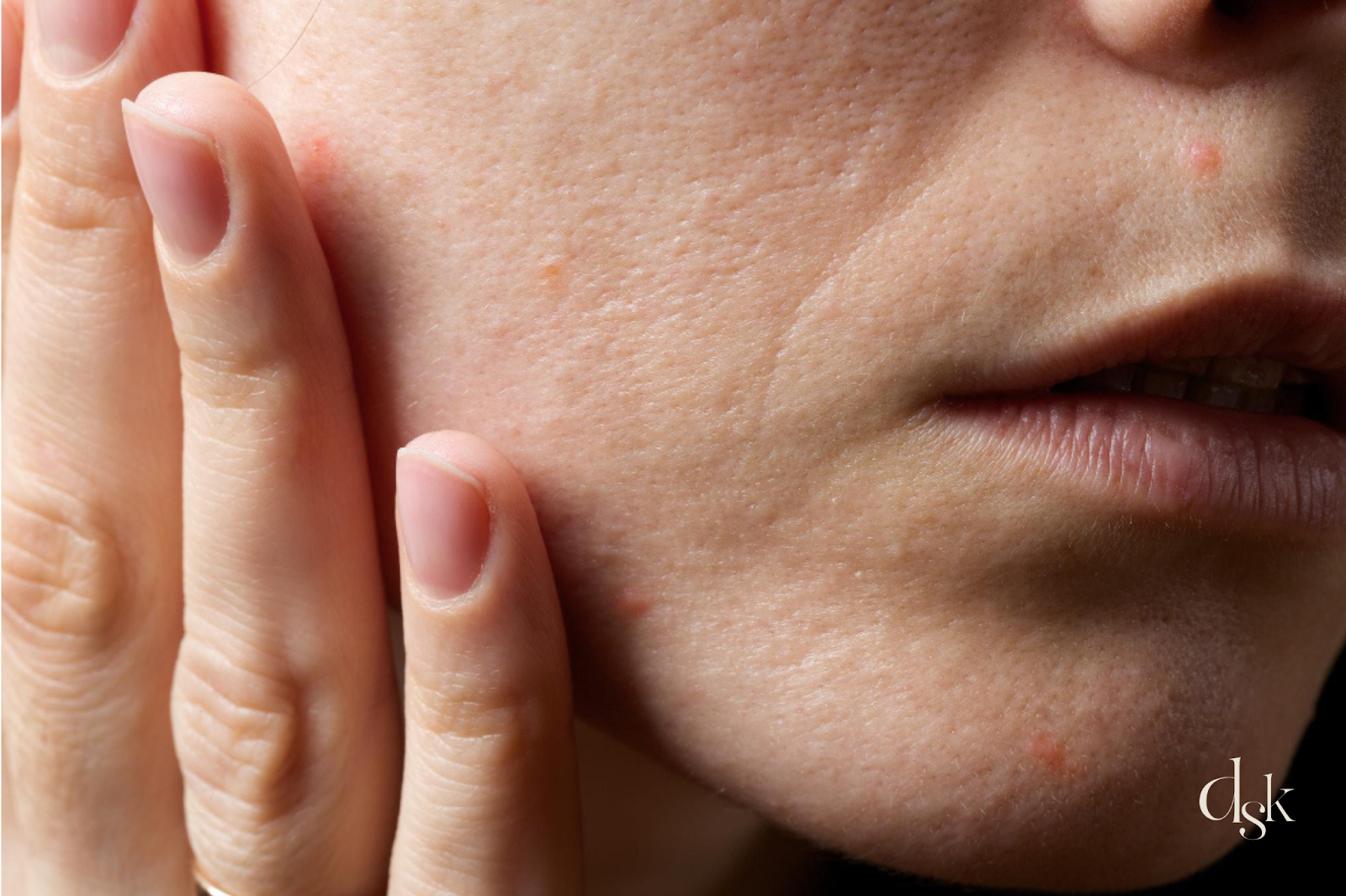 Vitaran รอยสิว