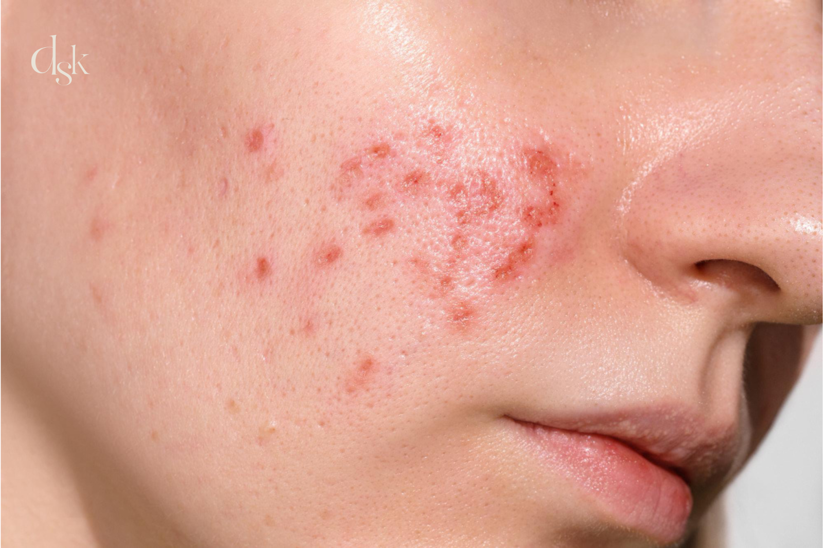 ลดรอยสิวที่ DSK Clinic