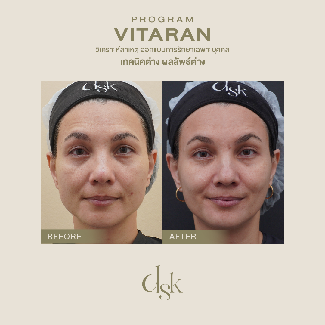 รีวิว vitaran