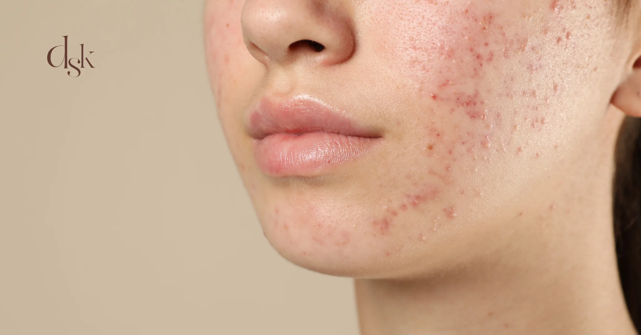 ปัญหาผิวในการทำโปรแกรม Pico Laser