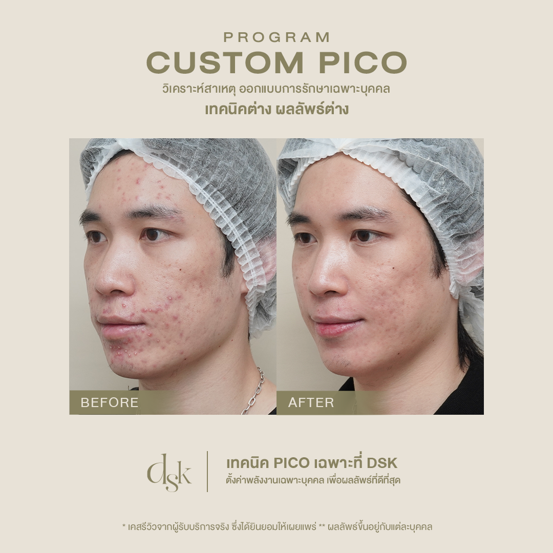 รีวิวผลลัพธ์ก่อน-หลัง ทำโปรแกรม Pico Laser จาก DSK Clinic