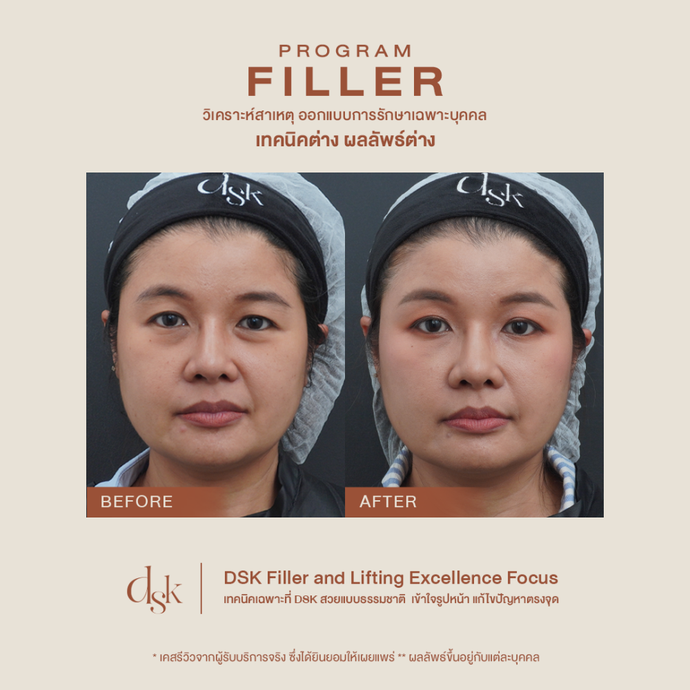 hn.B68-002236_filler ใต้ตาหน้าแก้มร่องแก้ม5cc