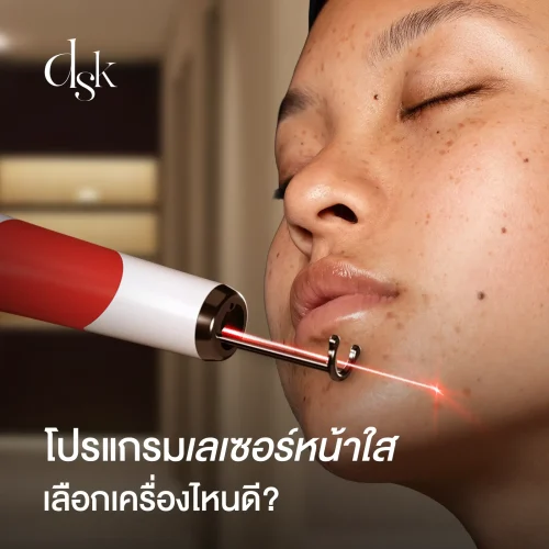 โปรแกรมเลเซอร์หน้าใส ลดรอยดำ รอยแดง หลุมสิวตื้นขึ้น เลือกเครื่องไหนดี?