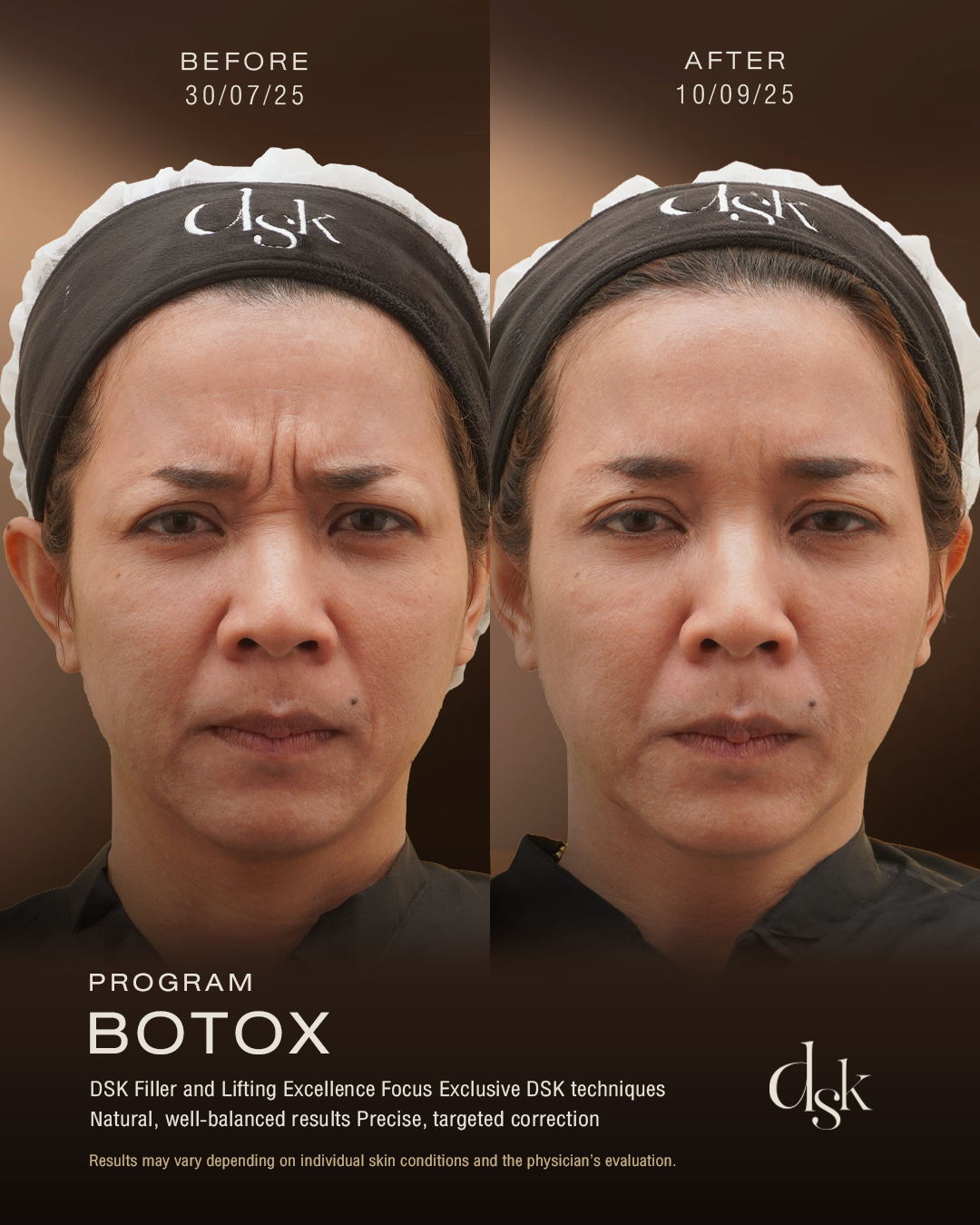 Botox Review at DSK Clinic