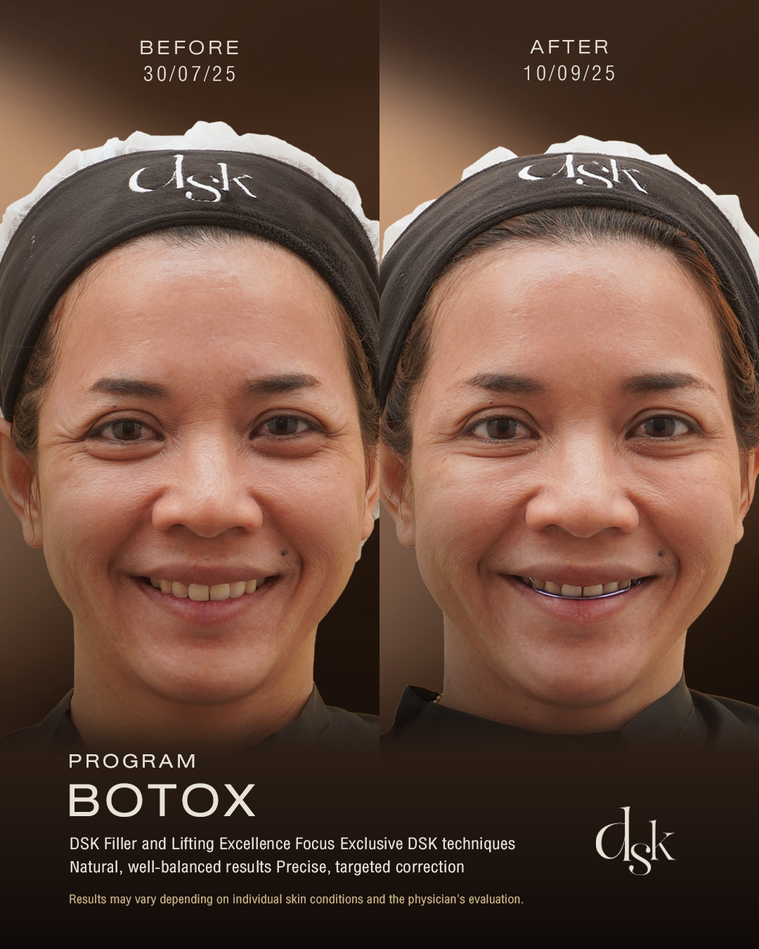 Botox Bangkok DSK Clinic