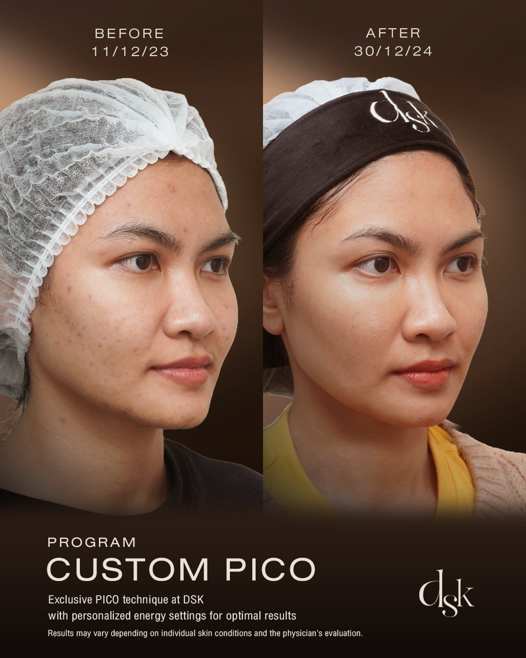 Pico Laser Bangkok Clinic