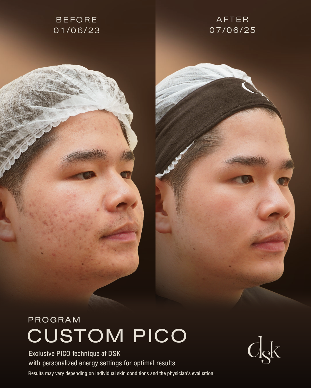 Pico Laser Bangkok Thailand