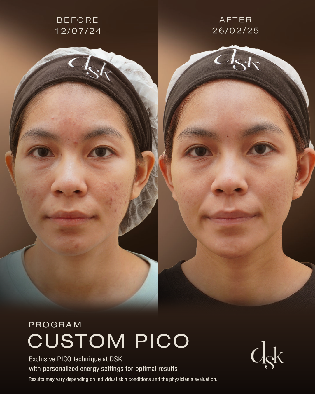Pico Laser DSK Clinic