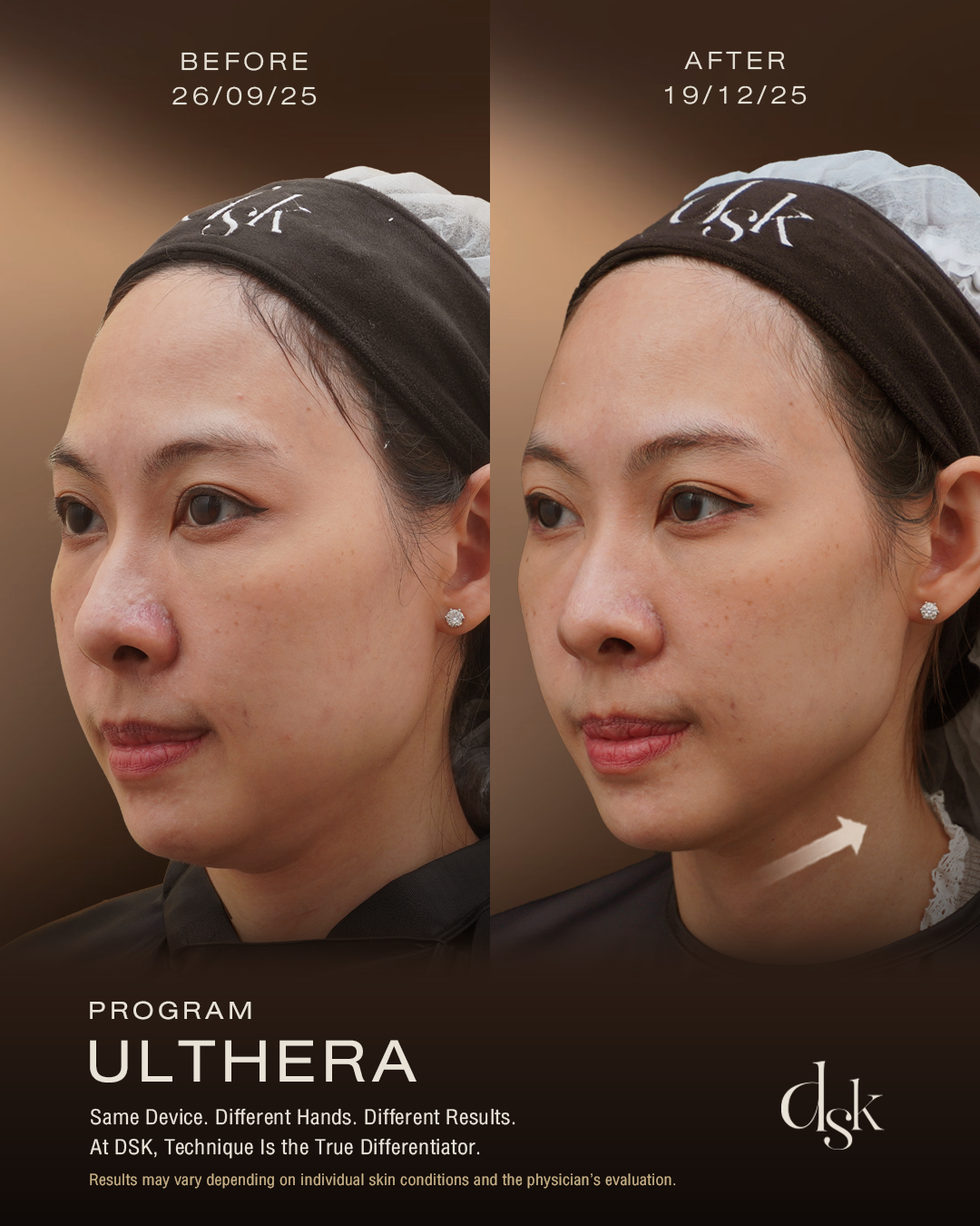 ultherapy before and after