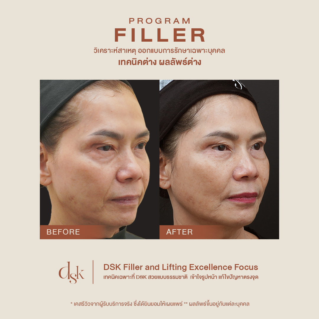 Filler Lorient รีวิว