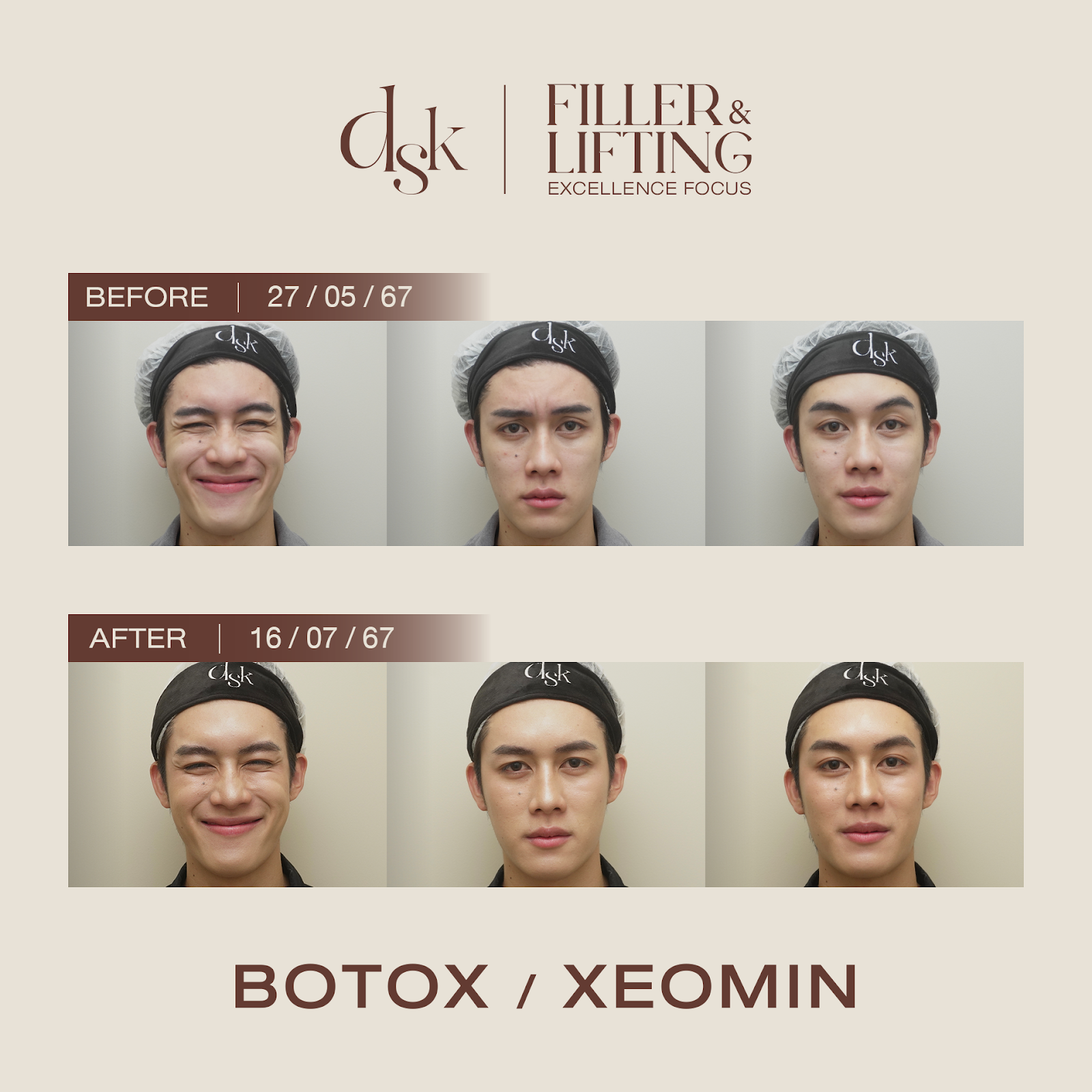 รีวิว xeomin