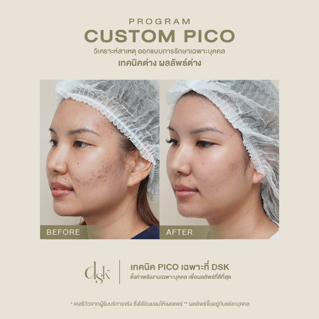 pico laser review bangkok