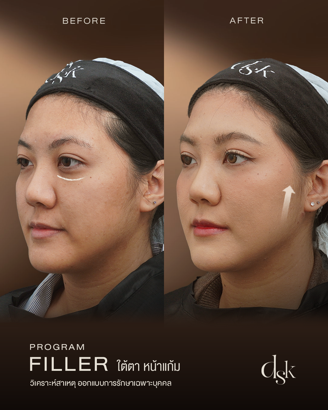 dermal fillers Bangkok