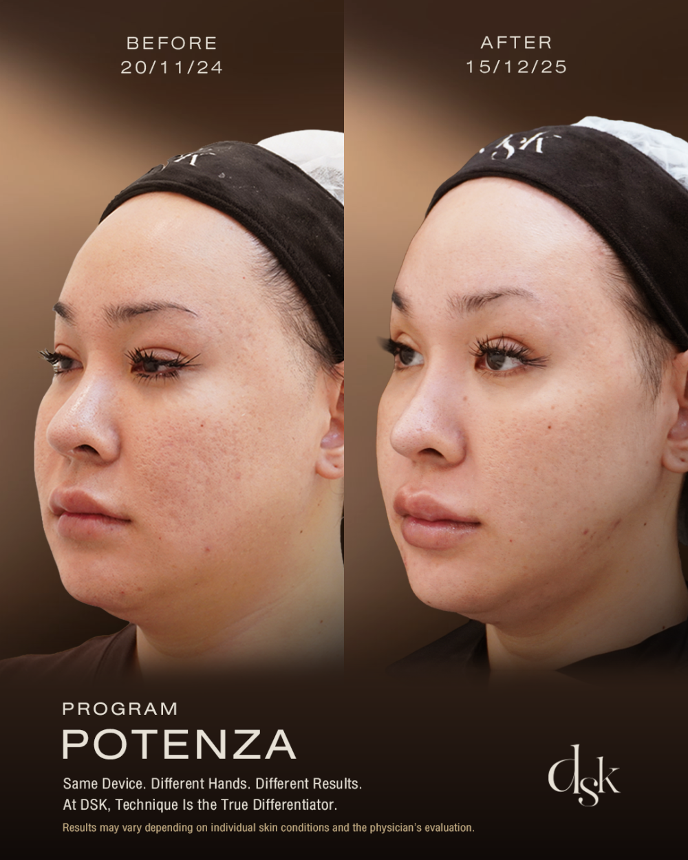 Potenza Review at DSK Clinic