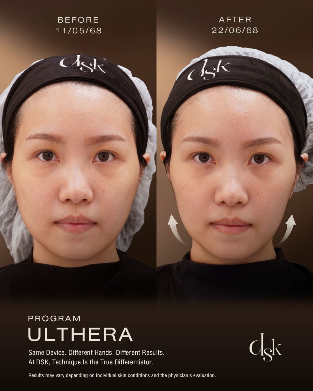 Ulthera Prime DSK Clinic