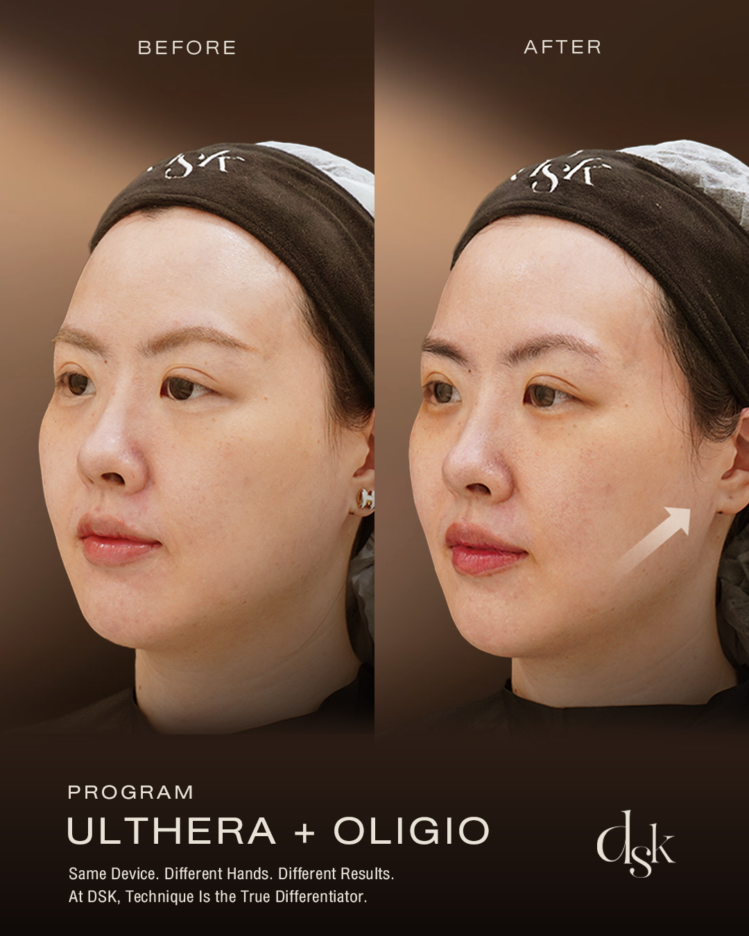 Ulthera Review DSK Clinic