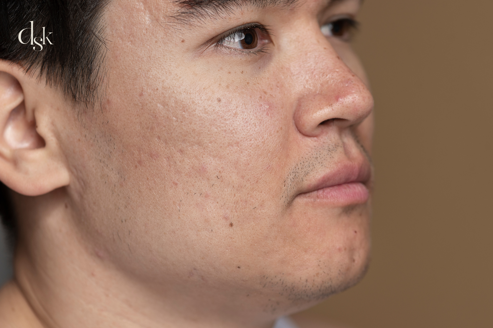 Potenza acne scar