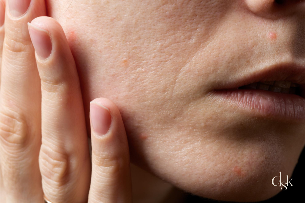 Vitaran acne scar