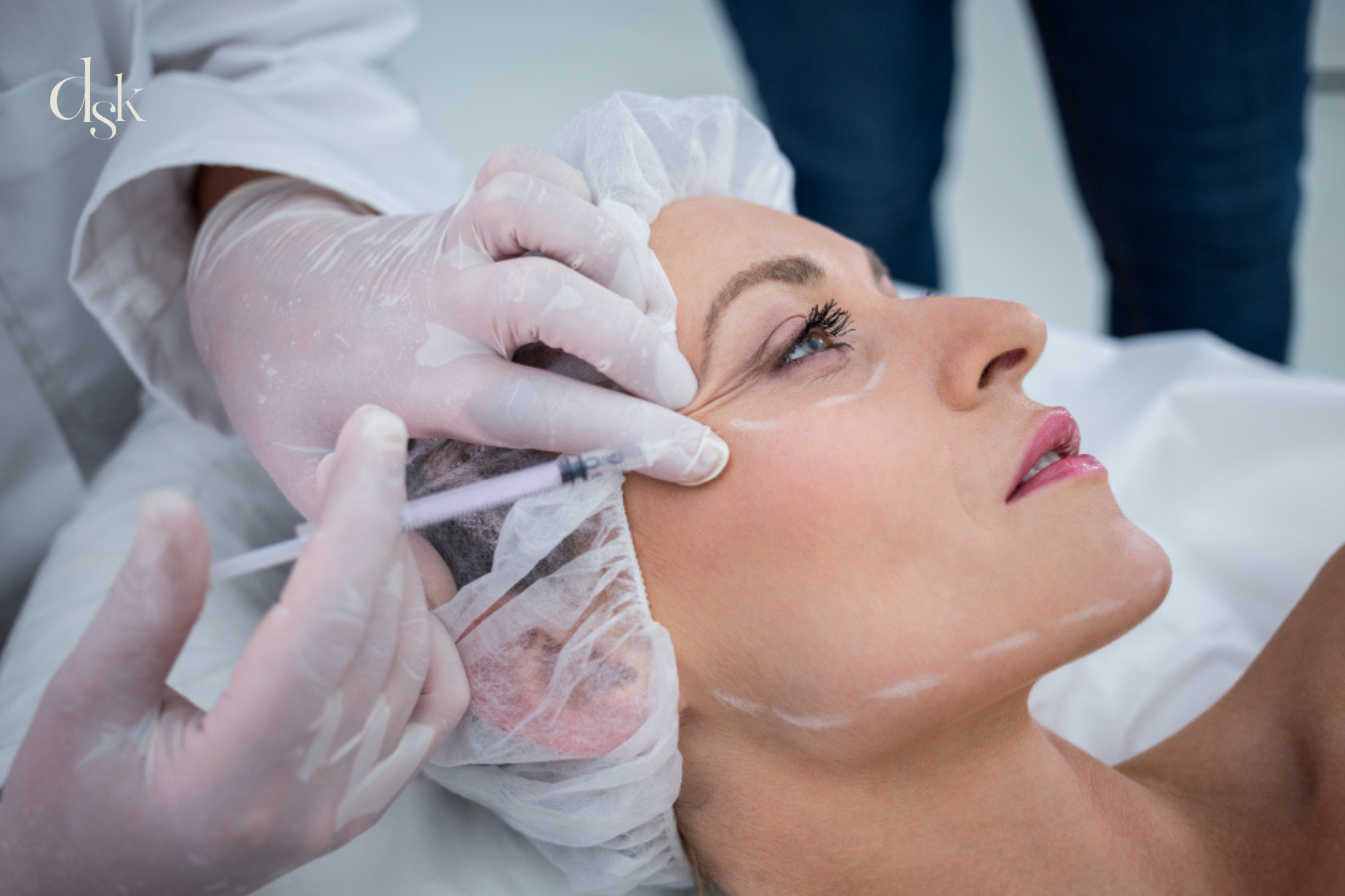 radiesse biostimulator
