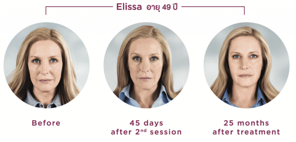 Sculptra clinic bangkok