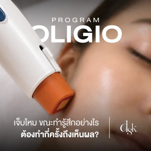 โปรแกรม Oligio เจ็บไหม ขณะทำรู้สึกอย่างไร ต้องทำกี่ครั้งถึงเห็นผล?