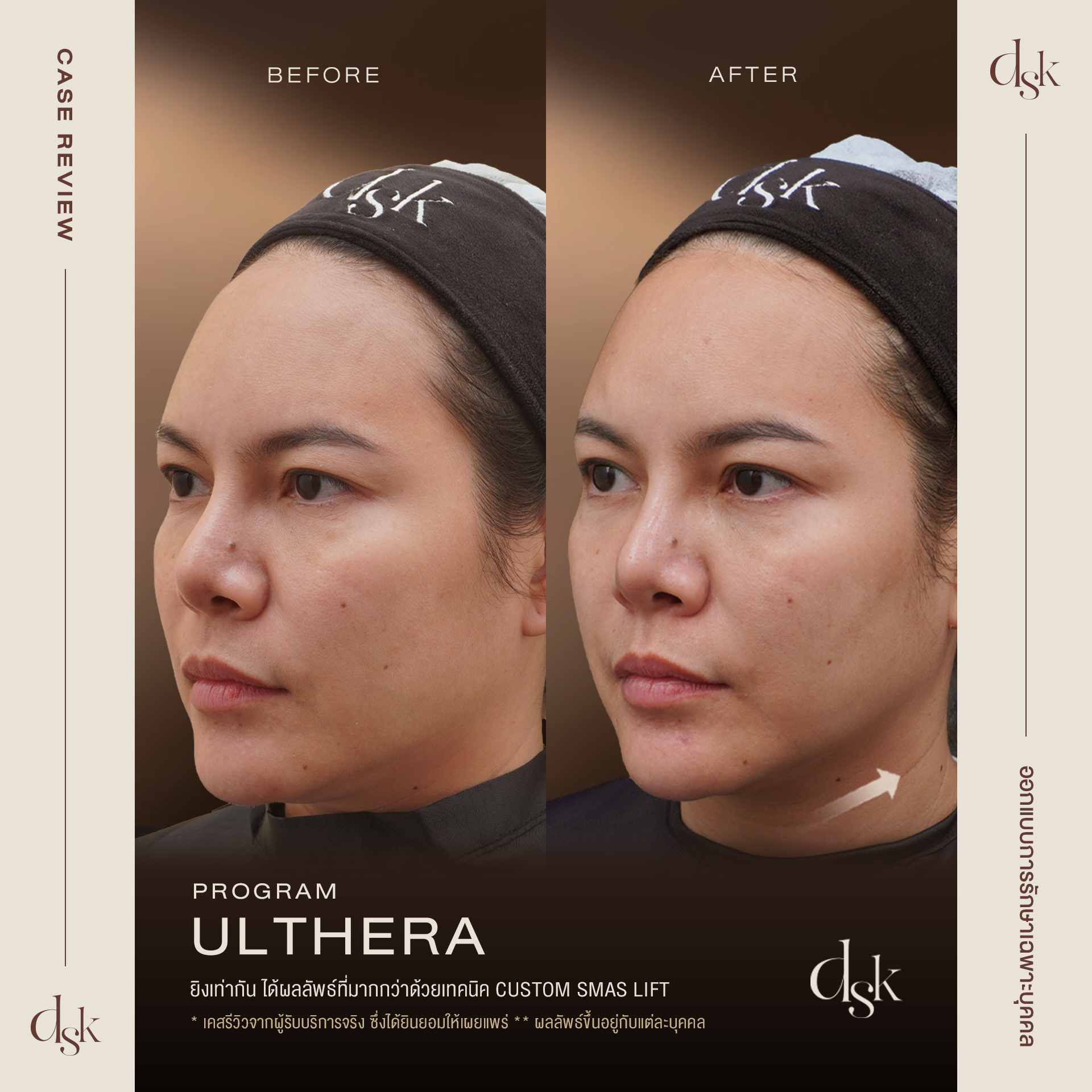 ulthera รีวิว dsk clinic
