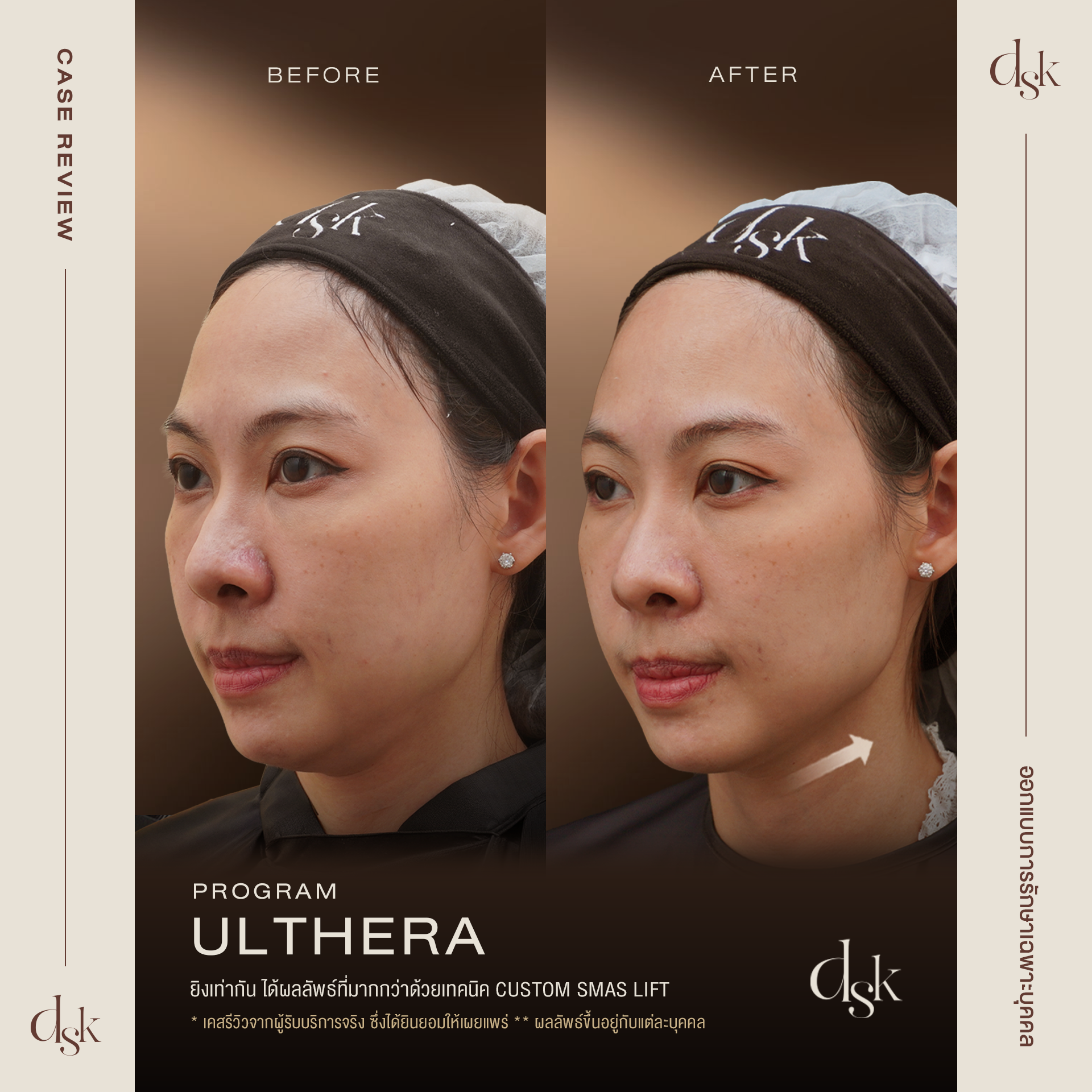 รีวิว ulthera
