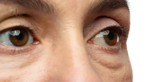 ถุงใต้ตาบวมมีสาเหตุมาจากอะไร รักษาแบบไม่ผ่าตัดด้วยโปรแกรม Thermage Eye
