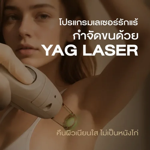 โปรแกรมเลเซอร์รักแร้ กำจัดขนด้วย YAG Laser คืนผิวเนียนใส ไม่เป็นหนังไก่