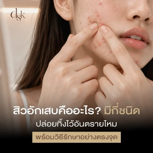 สิวอักเสบคืออะไร? มีกี่ชนิด ปล่อยทิ้งไว้อันตรายไหม พร้อมวิธีรักษาอย่างตรงจุด