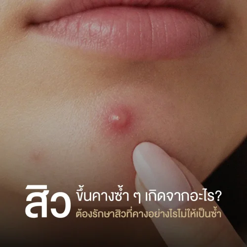 สิวขึ้นคางซ้ำ ๆ เกิดจากอะไร? ต้องรักษาสิวที่คางอย่างไรไม่ให้เป็นซ้ำ