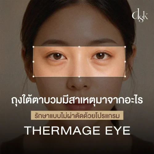 ถุงใต้ตาบวมมีสาเหตุมาจากอะไร รักษาแบบไม่ผ่าตัดด้วยโปรแกรม Thermage Eye