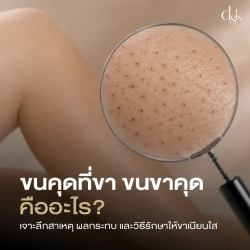 ขนคุดที่ขา ขนขาคุดคืออะไร? เจาะลึกสาเหตุ ผลกระทบ และวิธีรักษาให้ขาเนียนใส