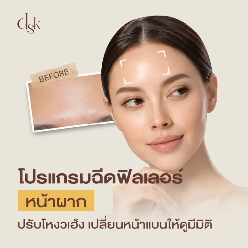 โปรแกรมฉีดฟิลเลอร์หน้าผาก แก้รอยหย่น หน้าผากแบน อันตรายไหม?
