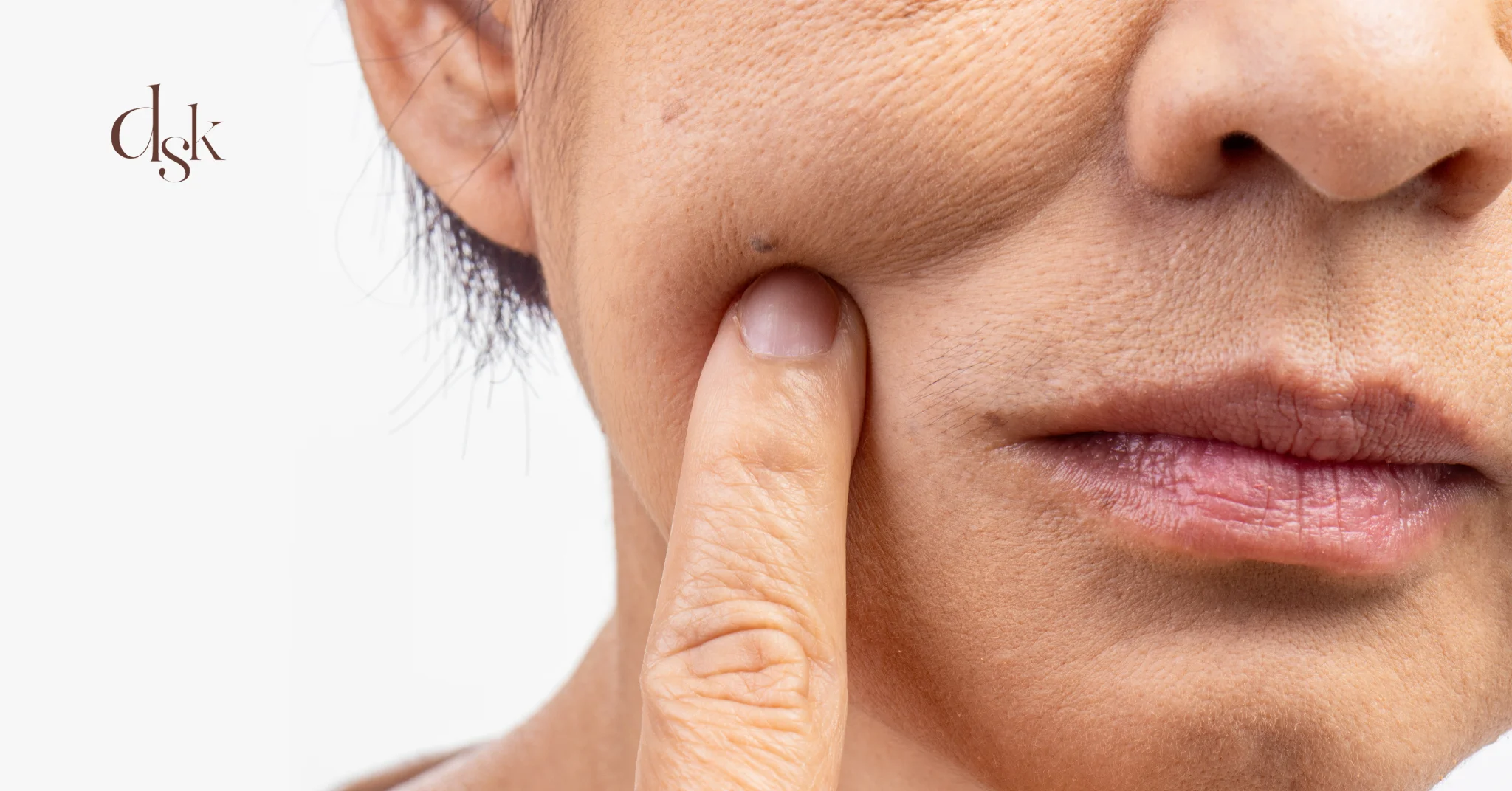 ปัจจัยใดเร่งให้ Hyaluronic Acid ในผิวลดลง