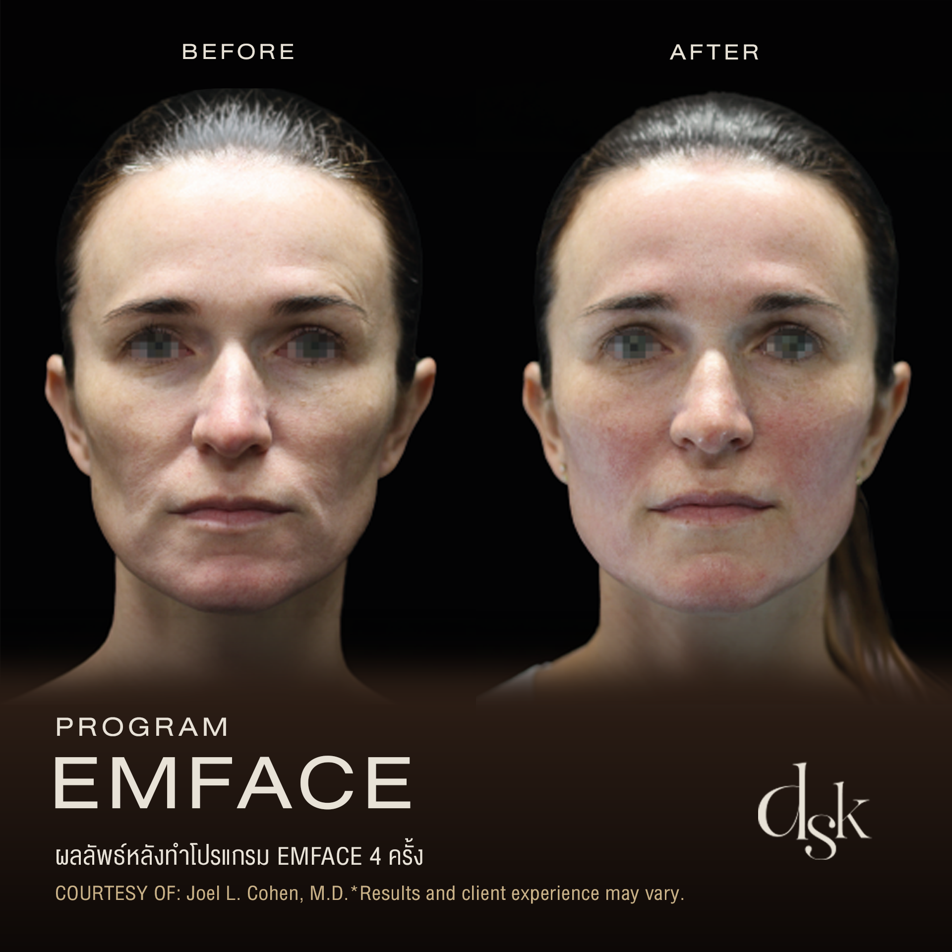 Emface รีวิว