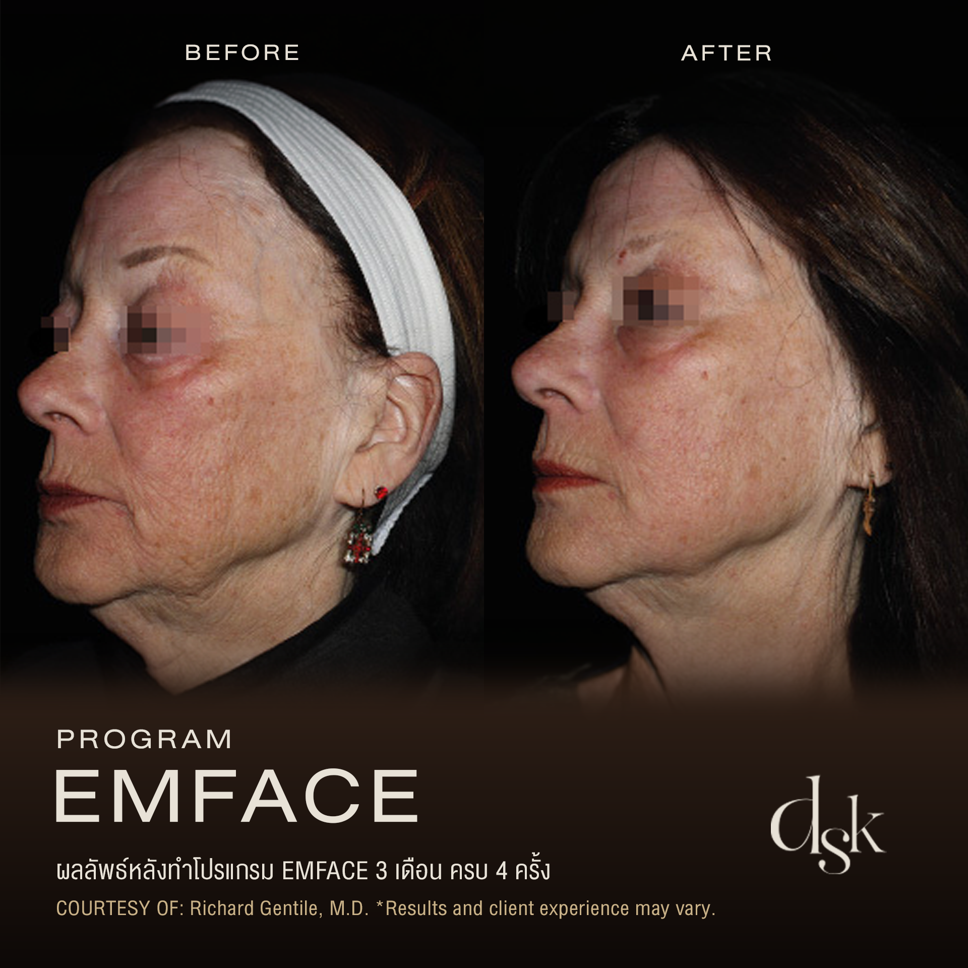 Emface ราคา