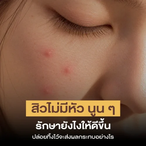 สิวไม่มีหัว นูน ๆ รักษายังไงให้ดีขึ้น ปล่อยทิ้งไว้จะส่งผลกระทบอย่างไร