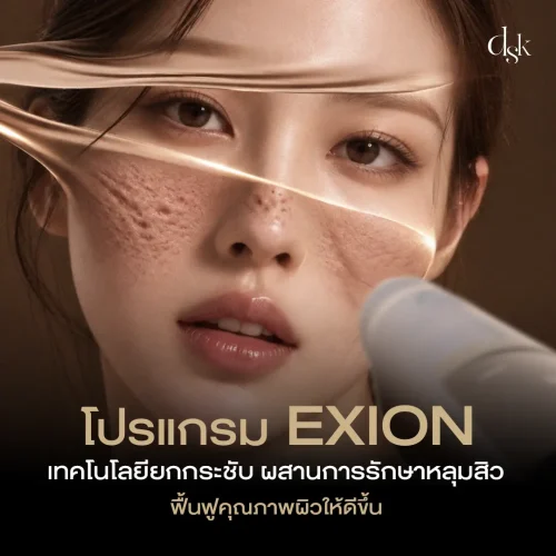 โปรแกรม EXION เทคโนโลยียกกระชับ ผสานการรักษาหลุมสิว ฟื้นฟูคุณภาพผิวให้ดีขึ้น 
