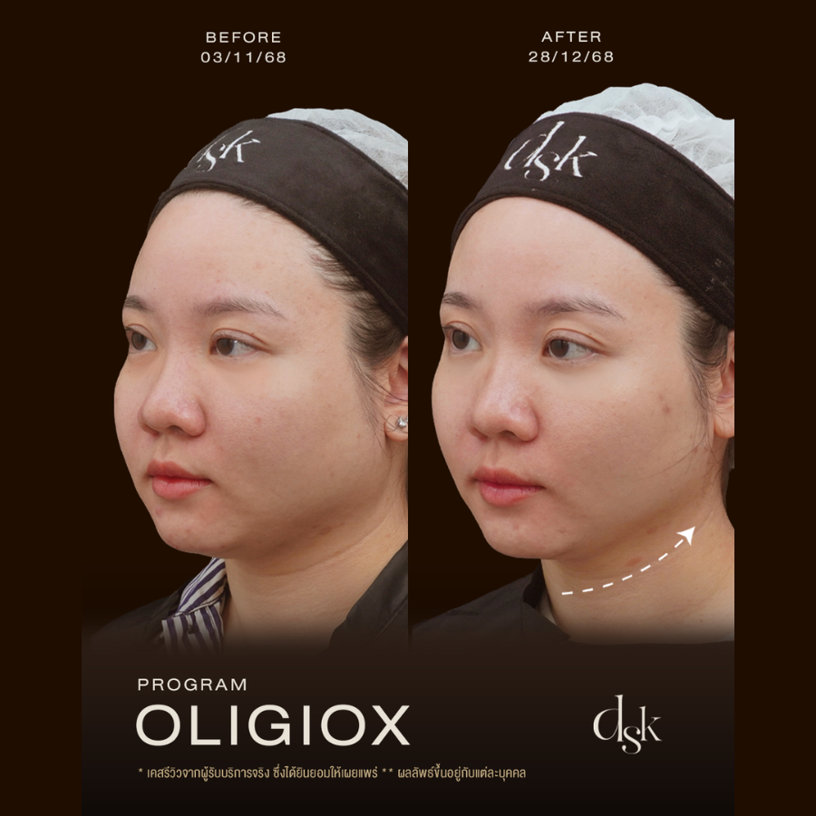 รีวิวทำโปรแกรม Oligio ที่ DSK Clinic