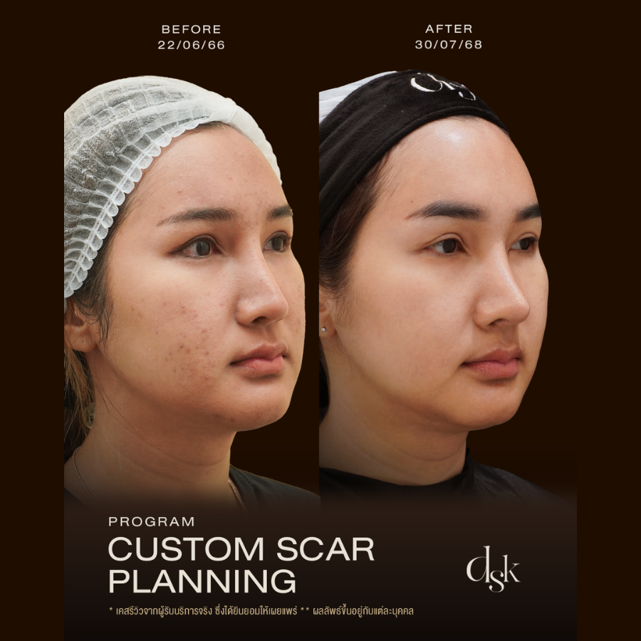 รีวิวโปรแกรมรักษาสิวที่ DSK Clinic