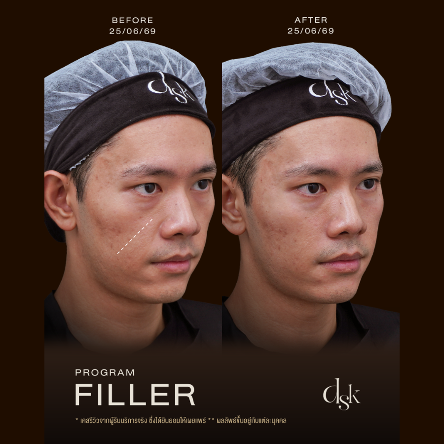 รีวิวโปรแกรมฟิลเลอร์ที่ DSK Clinic