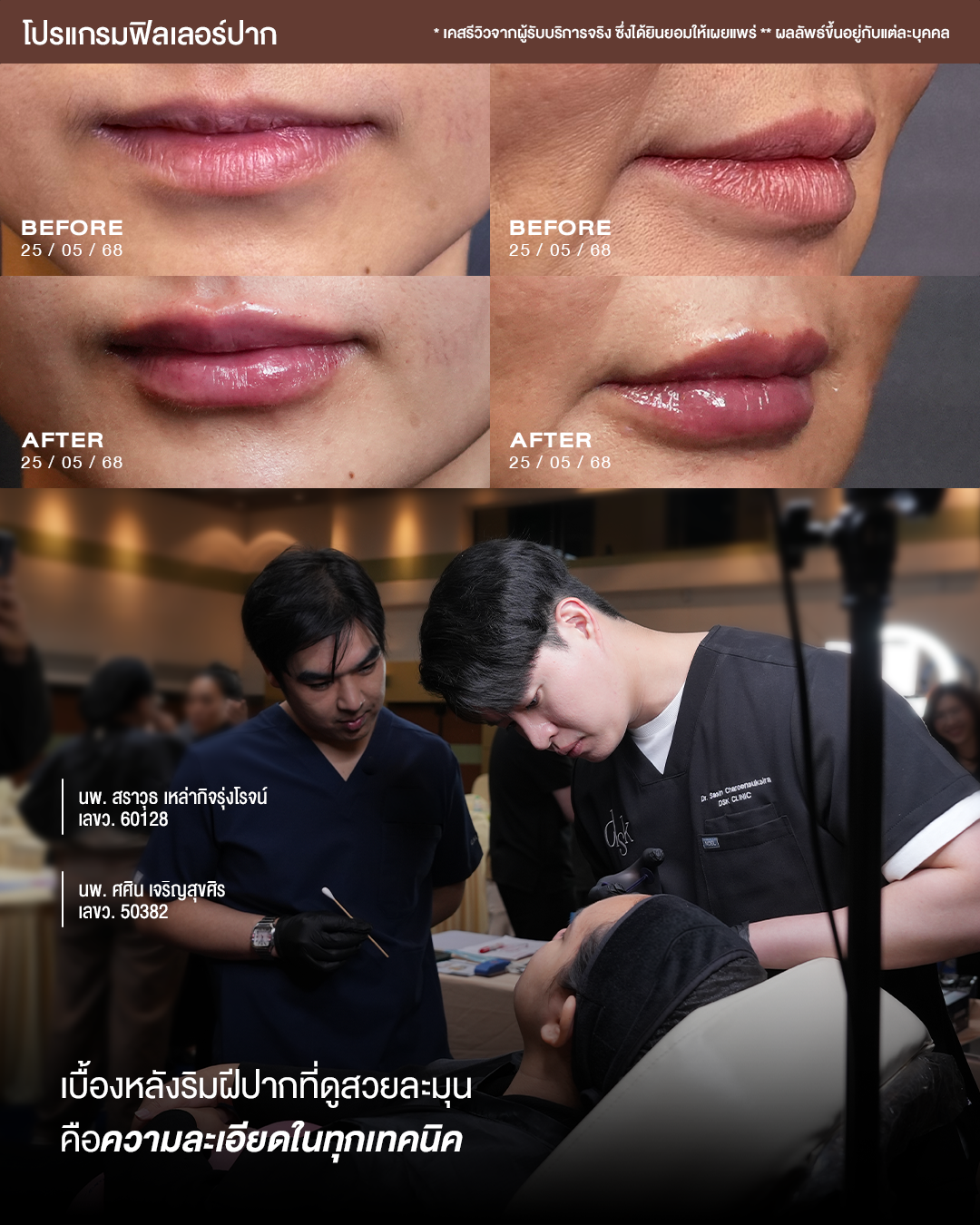 รีวิวโปรแกรมฟิลเลอร์ปากที่ DSK Clinic