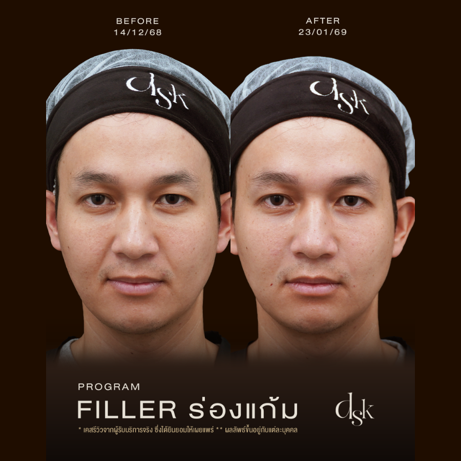รีวิวผลลัพธ์โปรแกรมฟิลเลอร์ร่องแก้มที่ DSK Clinic