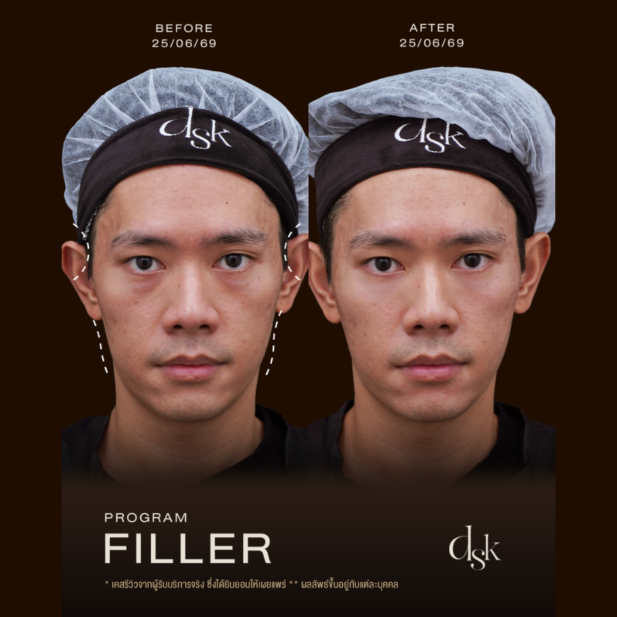 รีวิวโปรแกรมฟิลเลอร์ที่ DSK Clinic